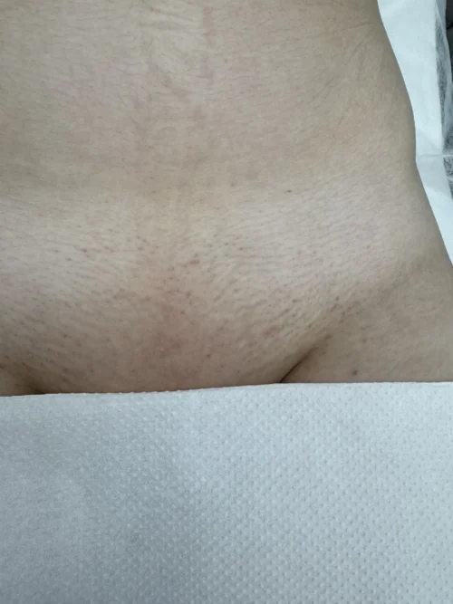 Після 3-х процедур