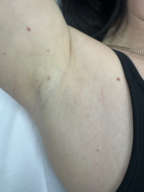 Після 3-х процедур