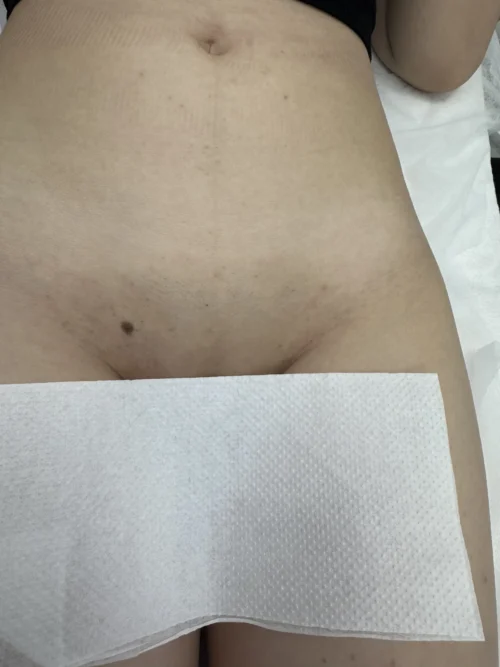 Після 3-х процедур