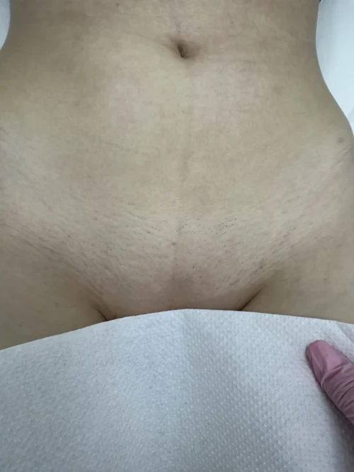 Після 7 процедур