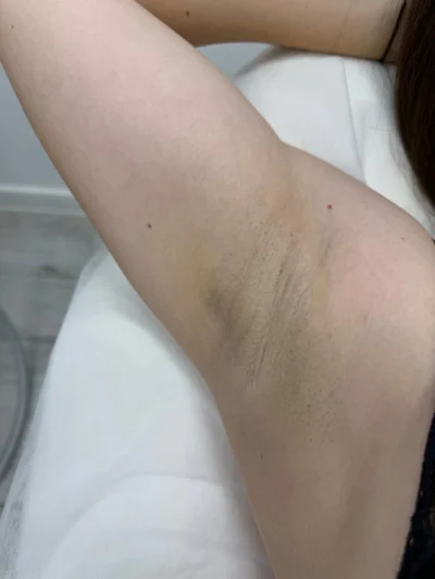 Після 3-х процедур