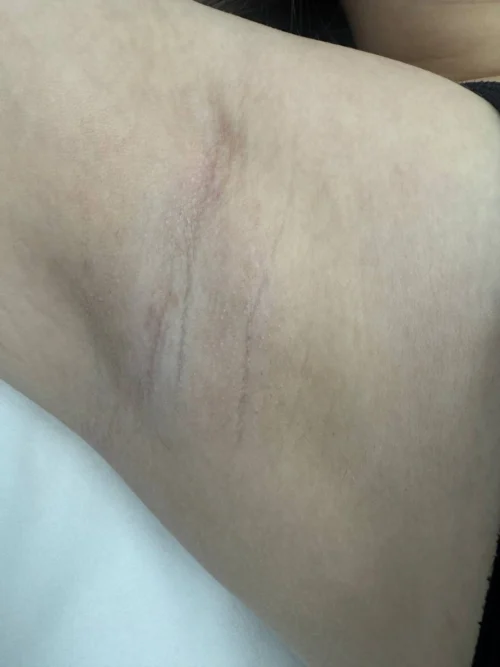 Після 4-х процедур