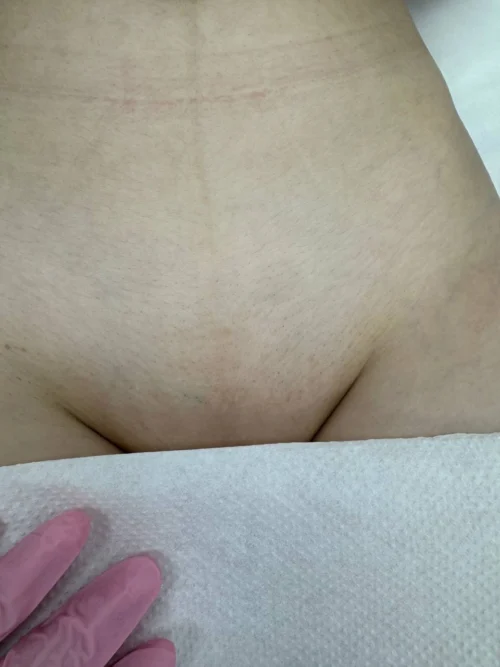 Після 6 процедур